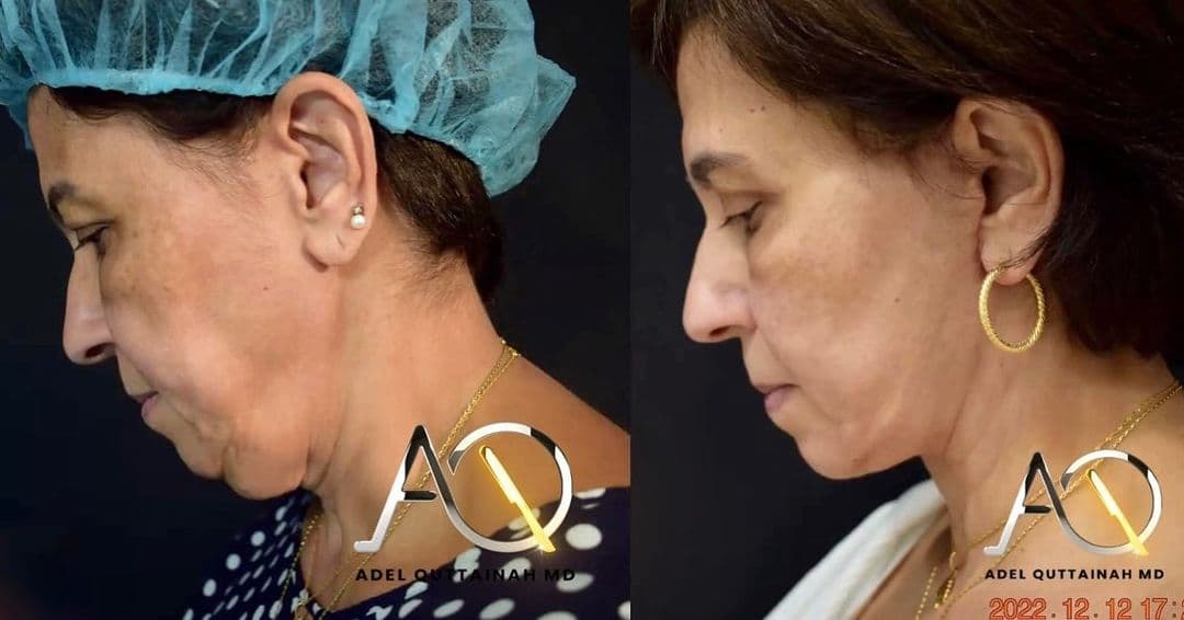 Face & Neck Lift Before and After